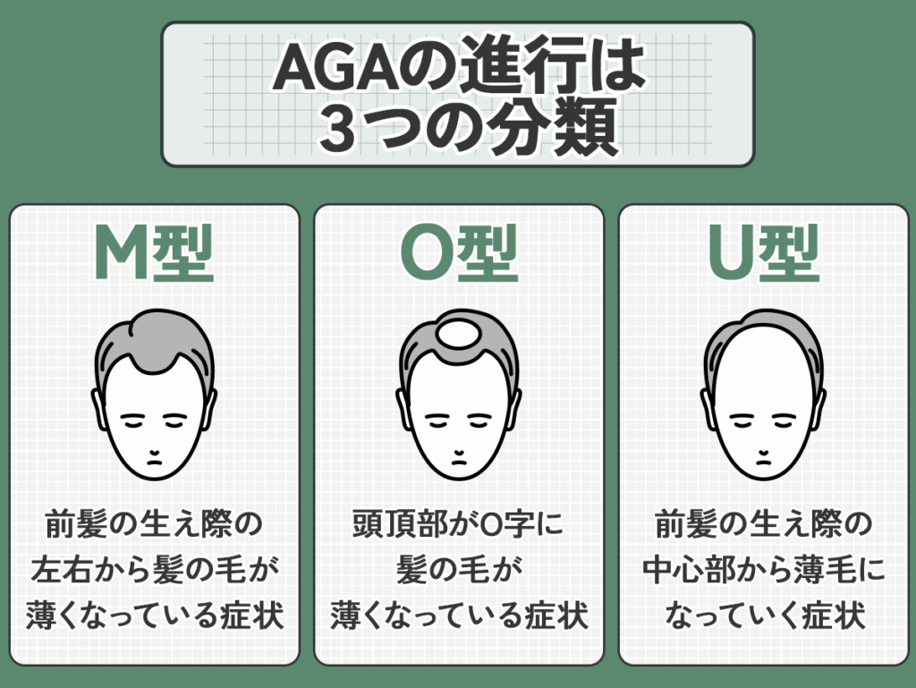 薄毛(AGA)の進行症状